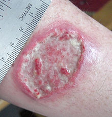 220px-Leishmaniasis_ulcer.jpg 220px-Leishmaniasis_ulcer.jpg